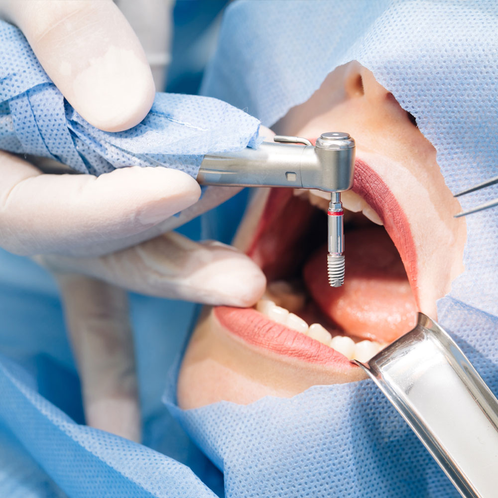 Proces pracy na implantami