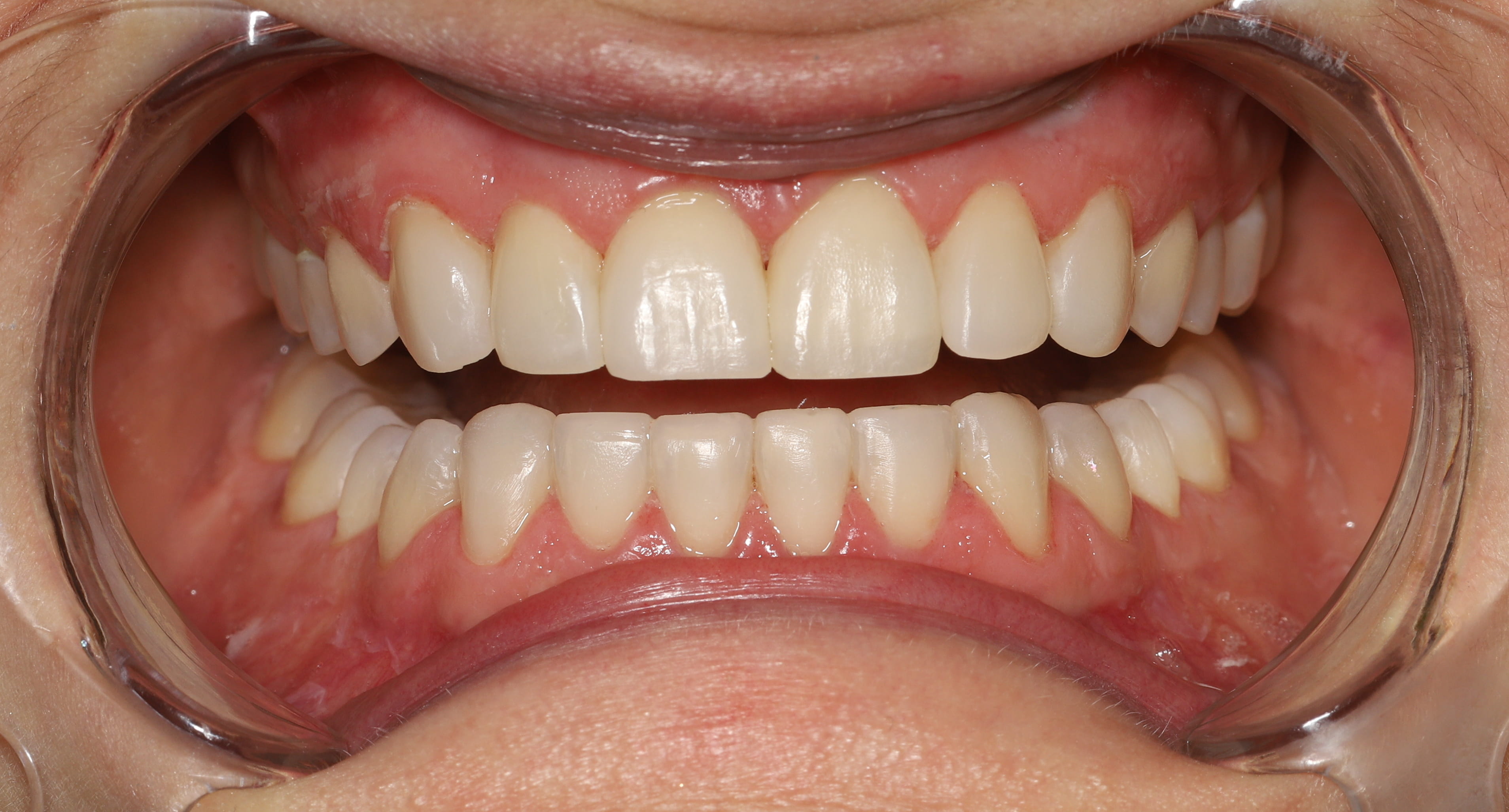 Bonding Rekonstrukcyjny