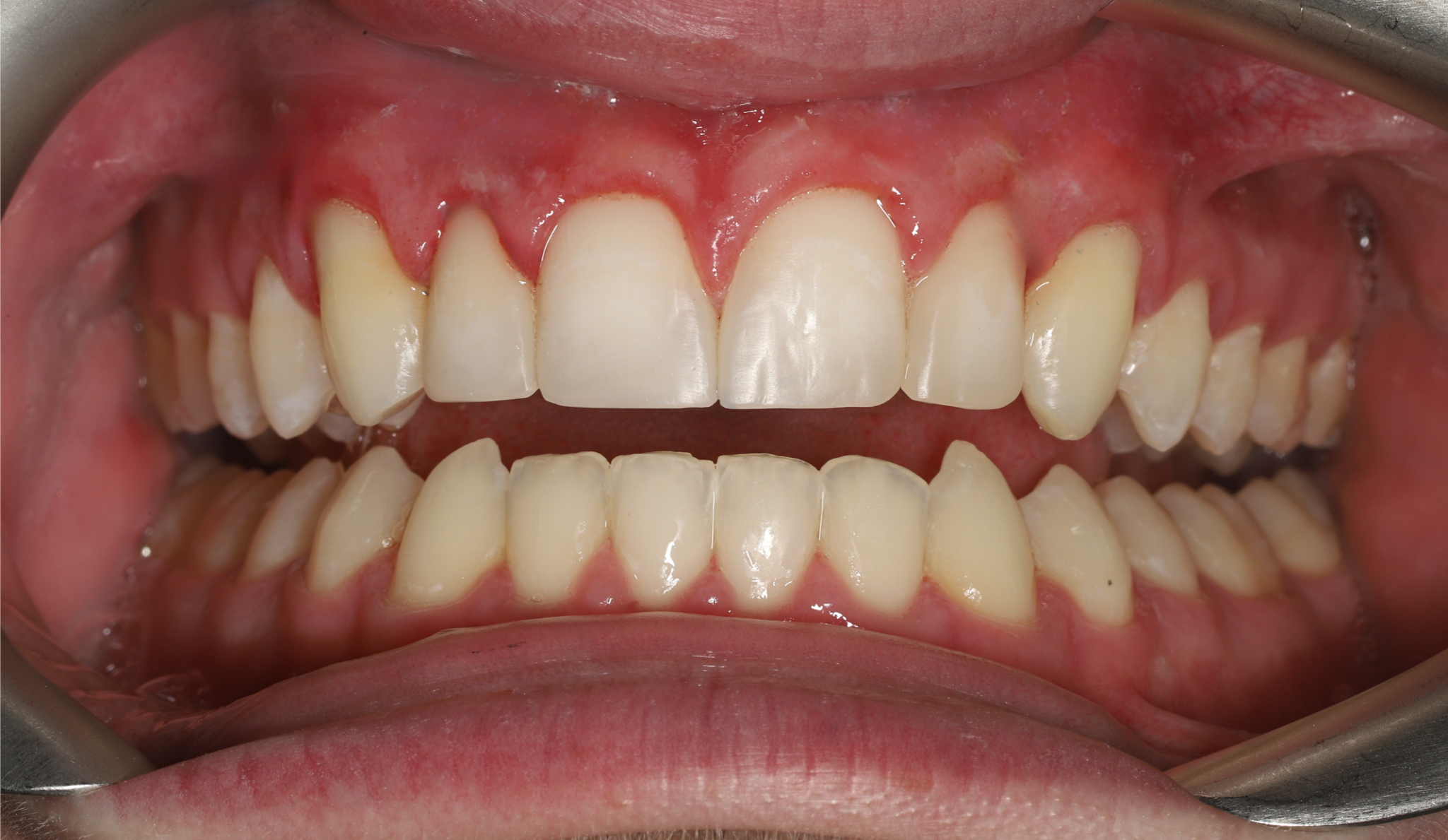 Bonding po leczeniem