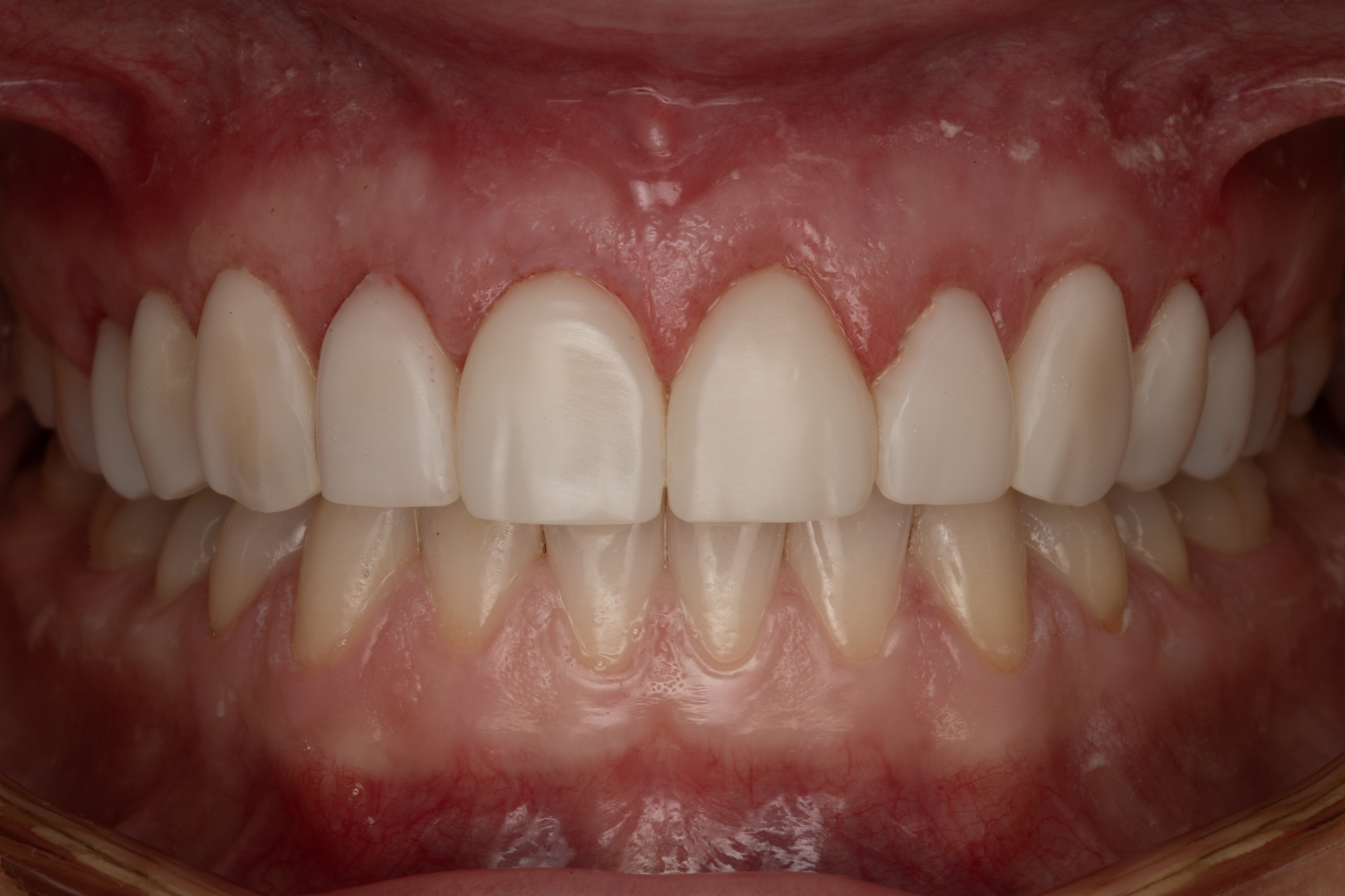 Bonding po leczeniem