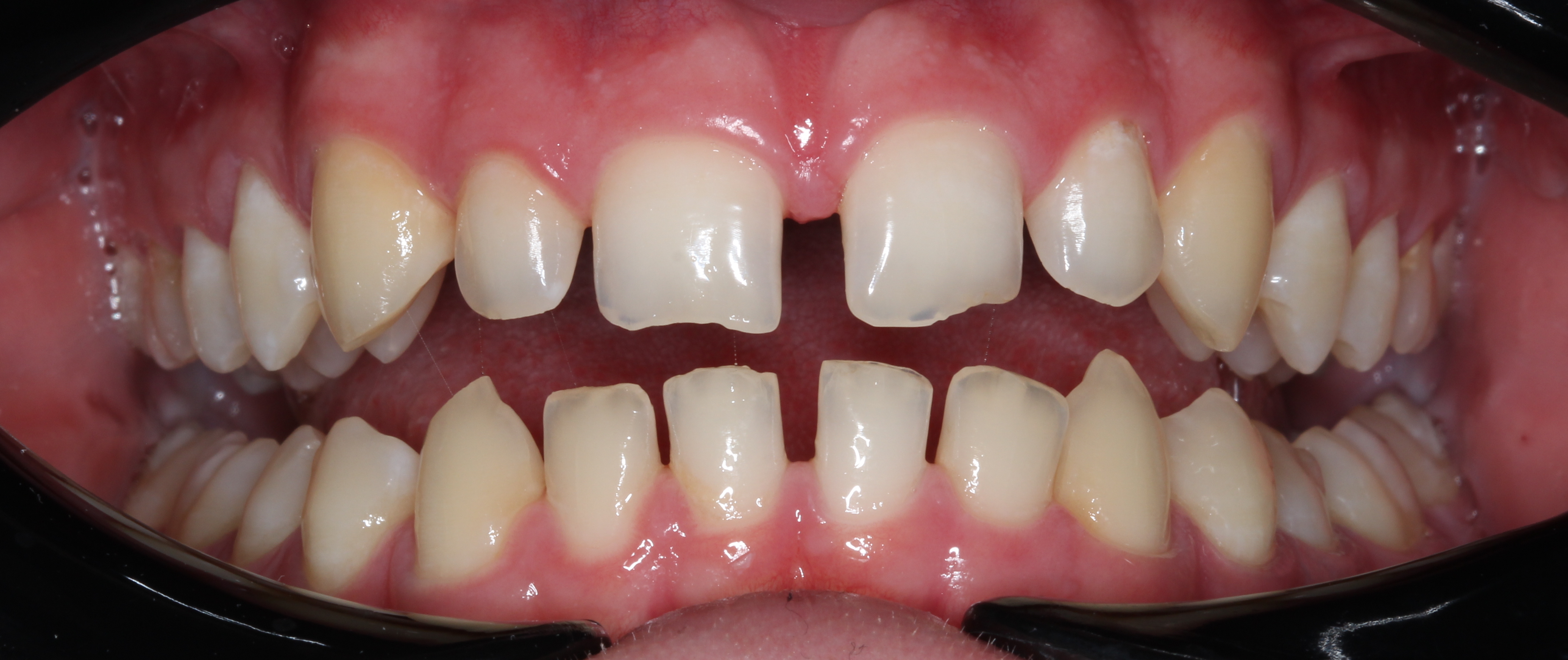 Bonding przed leczeniem