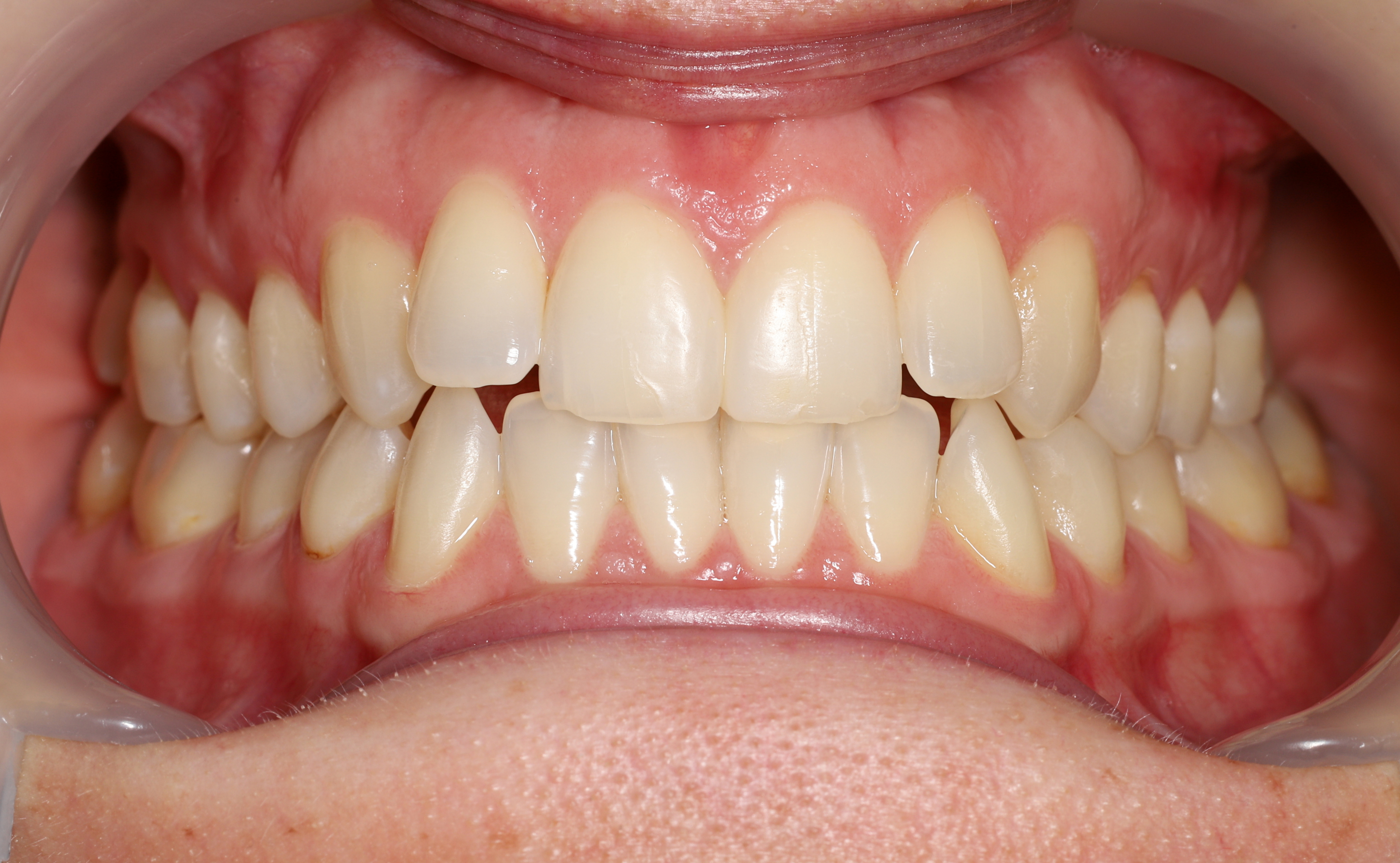 Bonding przed leczeniem