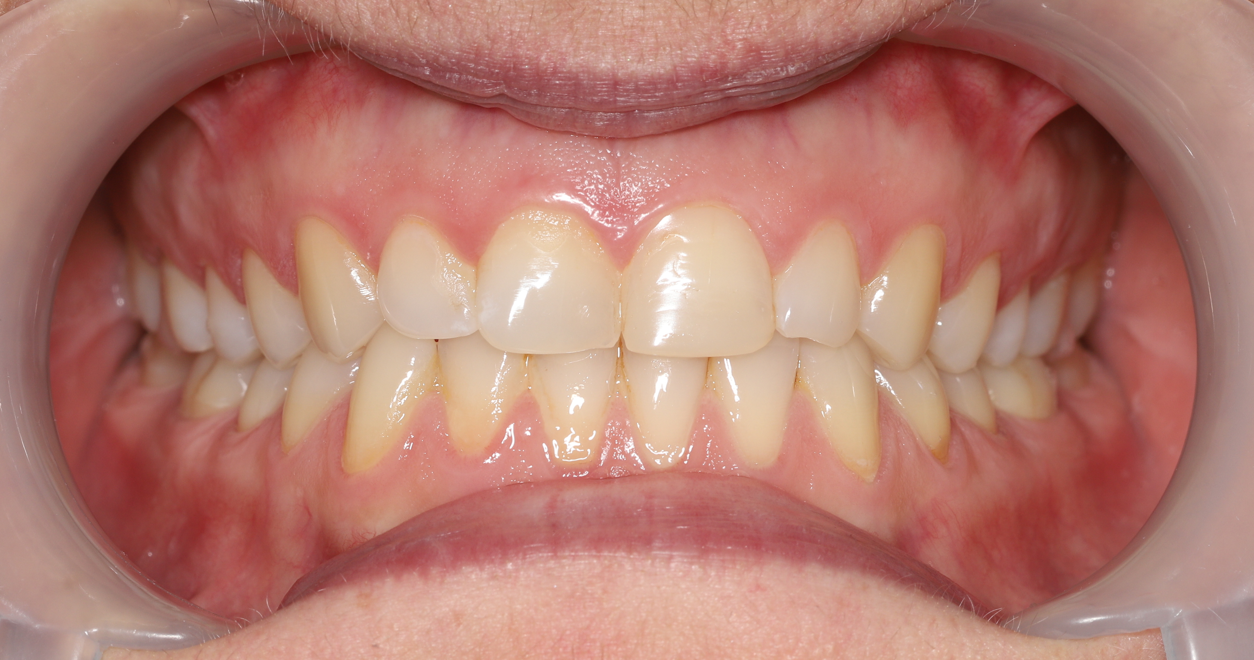 Bonding przed leczeniem